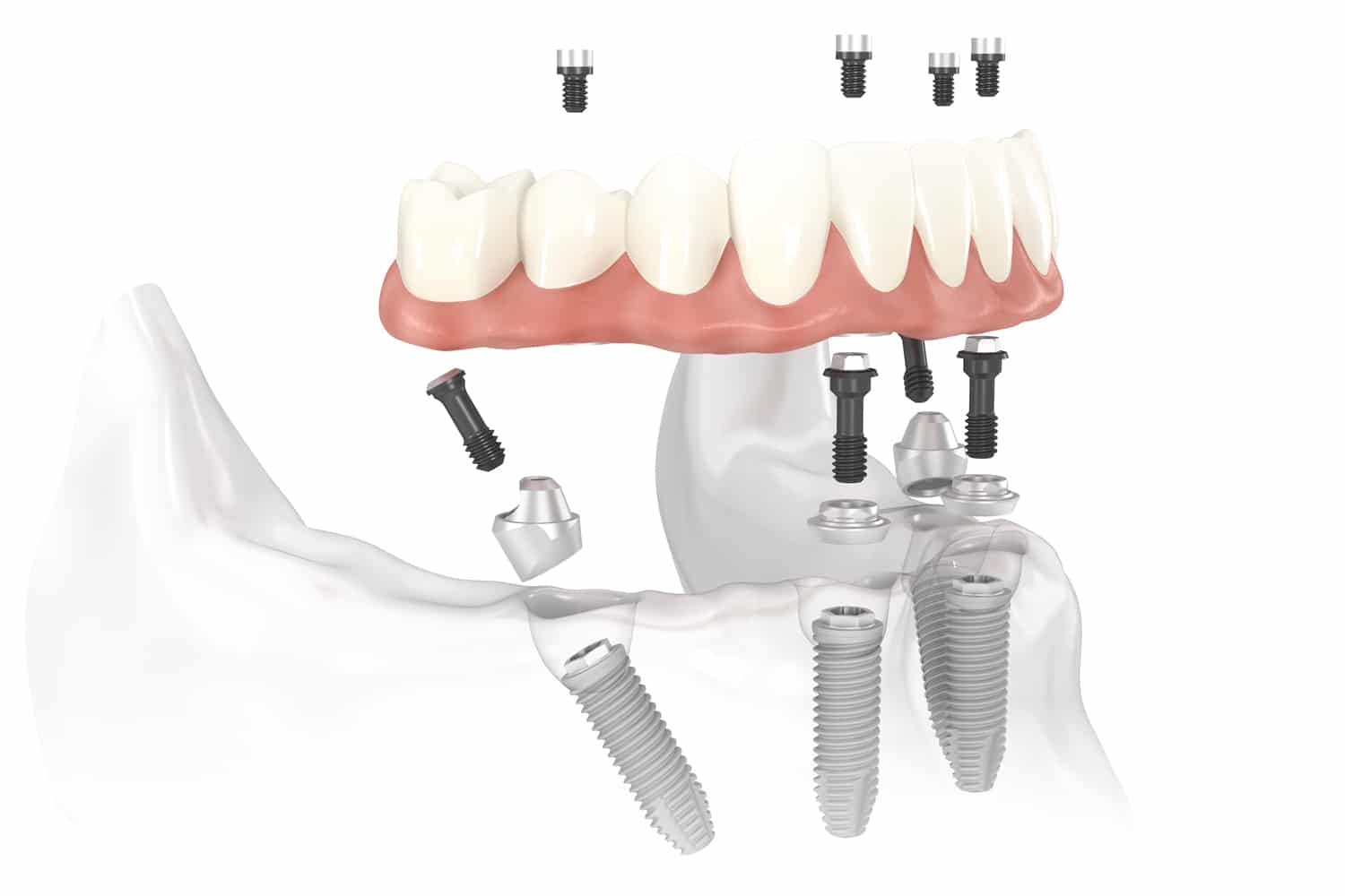 All-on-x Dental Implant System
