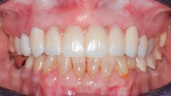 Restorative Dentistry Patient After