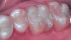 General Dentistry Patient After