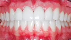 Restorative Dentistry Patient After