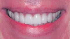 Dental Implants, Crowns & Invisalign