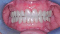 Procedure Performed: Porcelain Veneers, Crowns, Dental Implants & Clear Aligners