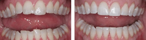 Dental Bonding Before and After