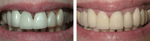 Dental Bridges Before & After