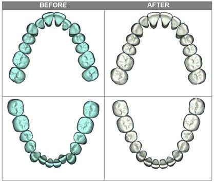 A set of teeth before and after of SureSmile®