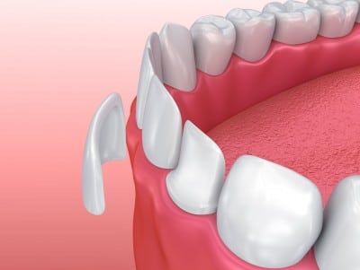 Example of Dental Veneers