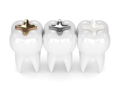Different kinds of fillings for cavities. 