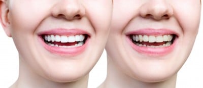 Fix chipped tooth with dental bonding