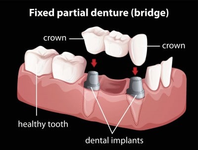 Example of dental bridge.