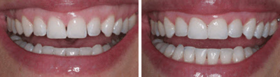 Closing a Black Triangle with BioClear.