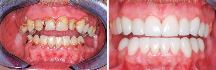 Before & After closeup of a patients teeth showing the difference restorative dentistry can make