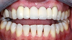 Restorative Dentistry Patient Before