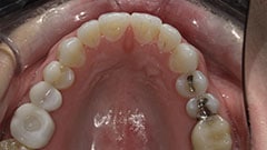 SureSmile Clear aligner therapy