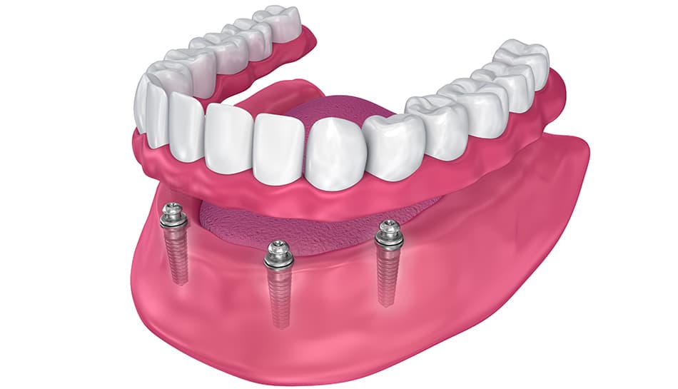 Snap on dentures detailed view