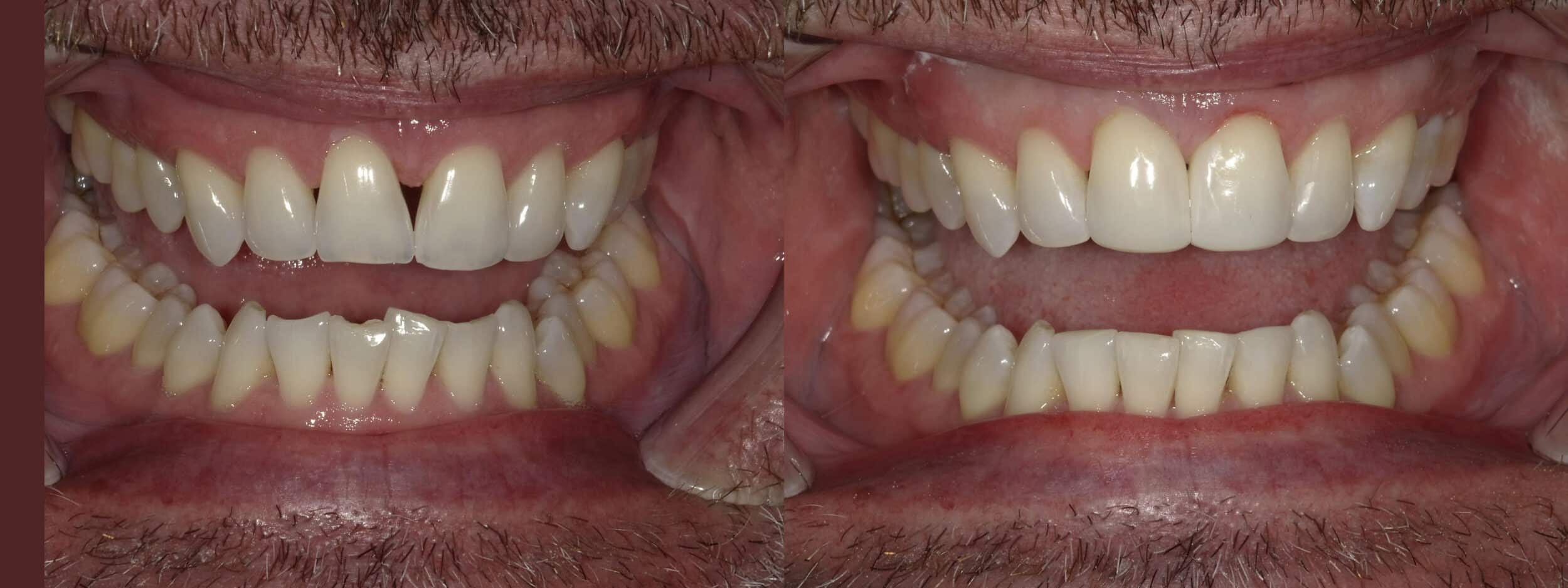 Before and After Image: Bioclear - front
